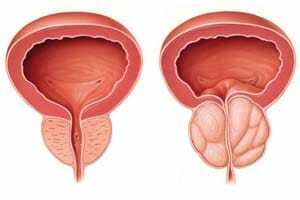Adenoma de la próstata