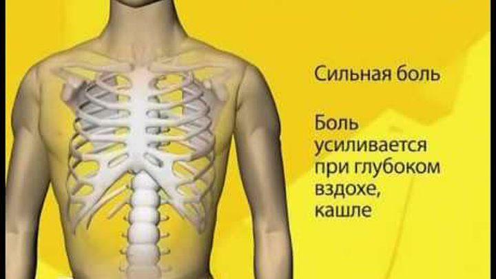 Signs of broken ribs