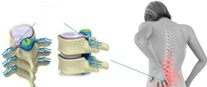 rehabilitation after an operation to remove the intervertebral hernia