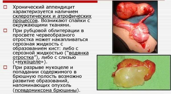 Appendectomy according to Volkovich-Dyakonov by pararectal incision according to Lenander