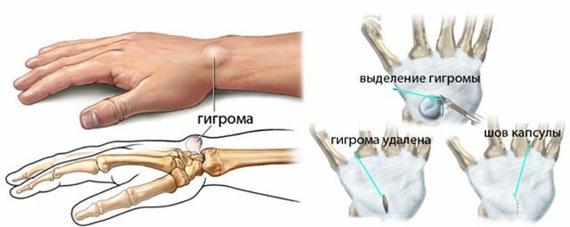 Operasi pengangkatan hygroma pergelangan tangan dan pengobatan dengan pengobatan tradisional