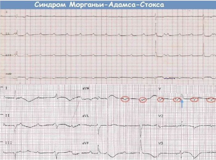 Frederick's syndrome on the ECG. What are these, signs, reasons