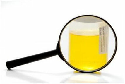 Analyse d'urine par Nechiporenko: norme, décodage, comment collecter