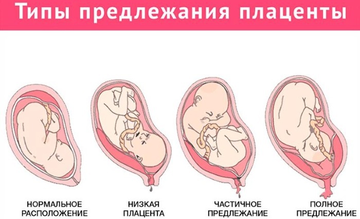 Apresentação pélvica do feto em 20-30-34 semanas de gestação. Entrega