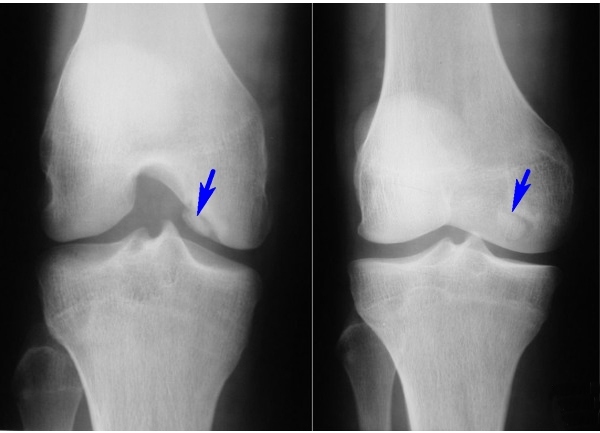 König's disease of the knee joint. What is it, treatment, stages in children, athletes, adults, surgery