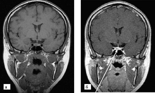 MRI hipofize s kontrastom. Cijena, što je to, kako to rade, što pokazuje, priprema