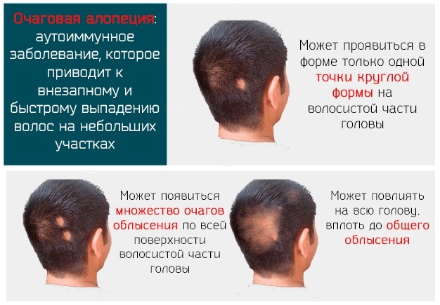 Sredstva protiv gubitka kose u muškaraca. Rangiranje najboljih u ljekarni, folk, šamponi, vitamini. cijene