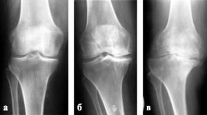 Röntgenfoto van de knie