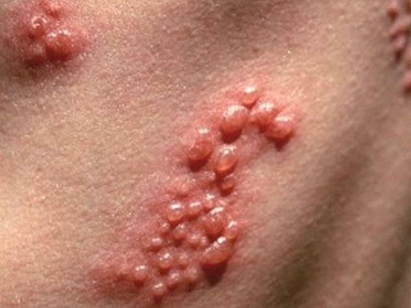 Skin rash with herpes zoster