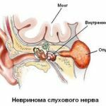 neurinoma van de gehoorzenuw