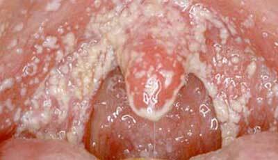 Hvid belægning, et tegn på candidiasis i mundhulen, foto 4