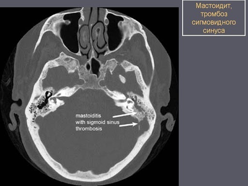 Mastoid. Where is it, what is it, photos, types of structure, inflammation, fracture, cholesteatoma, cell sclerosis