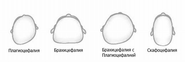 how to look like anomalies of the development of the skull