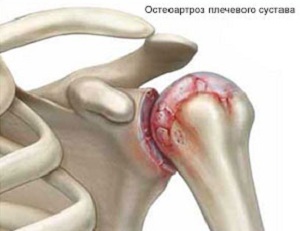 osteoarthritis of the shoulder joint