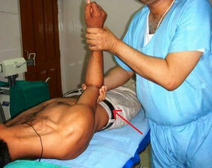 Direzione della dislocazione della spalla da parte del medico
