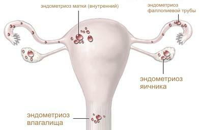 Az endometriózis helye