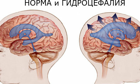 Hydrocephalus of the brain