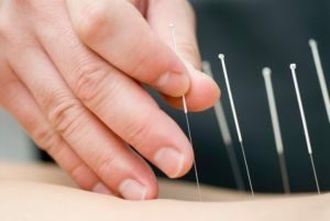 akupunkturna refleksoterapija