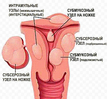 Uterine fibroids and pregnancy - on the posterior and anterior wall, of a large size, after the operation