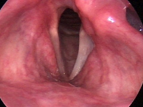 Paresis of the vocal cords. What is it, treatment, gymnastics