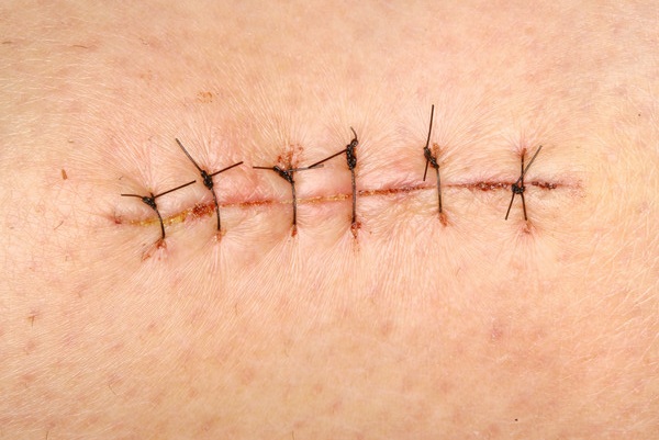 The postoperative suture does not heal: redness, induration, suppuration, gets wet, itches, hurts. Treatment