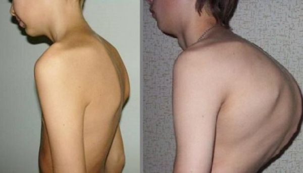 Back hump. Photos, reasons how to get rid