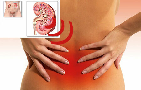 Simptomi ledvičnega peska pri ženskah in moških, zdravljenje, prehrana
