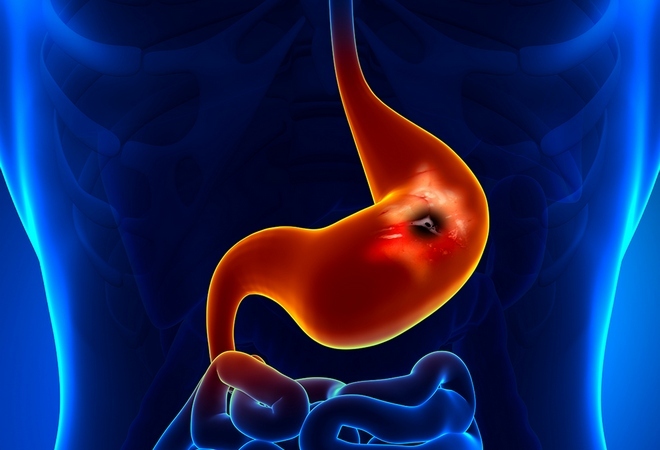 Gastrite aguda: sintomas e tratamento em adultos, os sintomas, como tratar