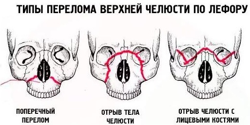 Fracture of the upper jaw. Treatment, first aid, symptoms, open, closed