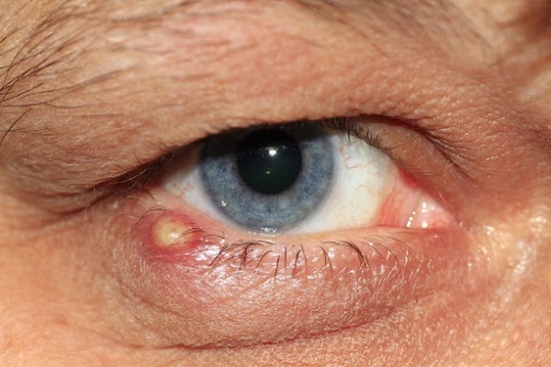 A pimple on the eyelid of the lower, upper, white eyes appeared. Treatment