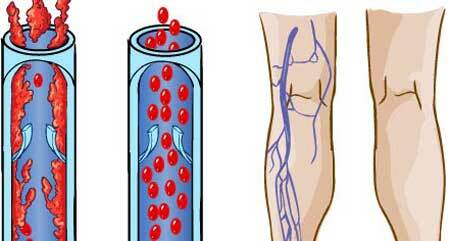 Les symptômes de la thrombose veineuse profonde des membres inférieurs