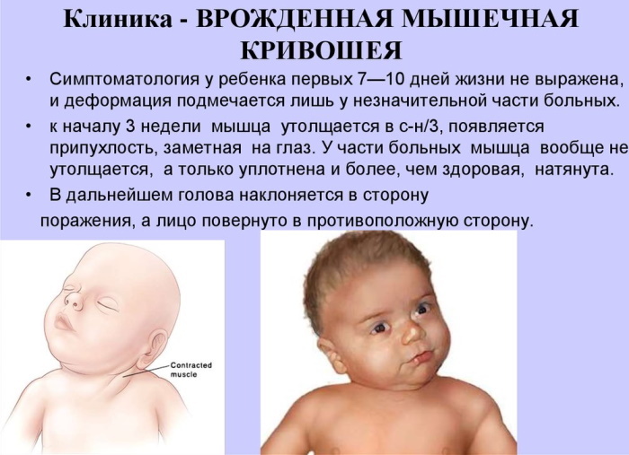 Tortícolis en bebés de 2-3-4-6 meses. Síntomas, fotos, tratamiento.