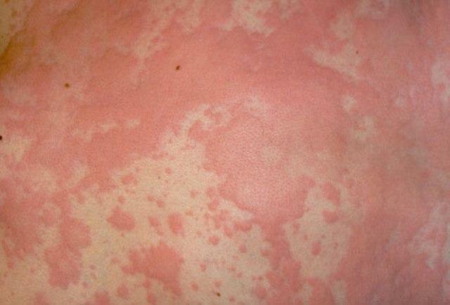 Ruam kulit dengan alergi