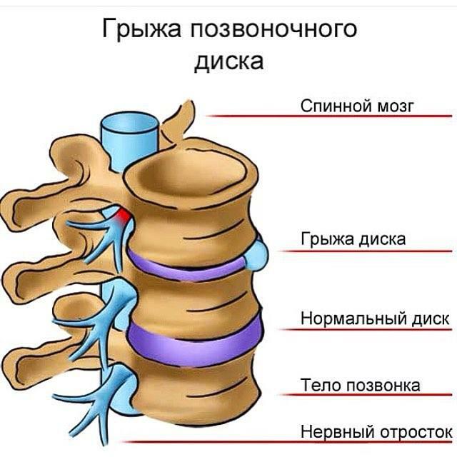Reprezentarea schematică a unui disc intervertebral herniat