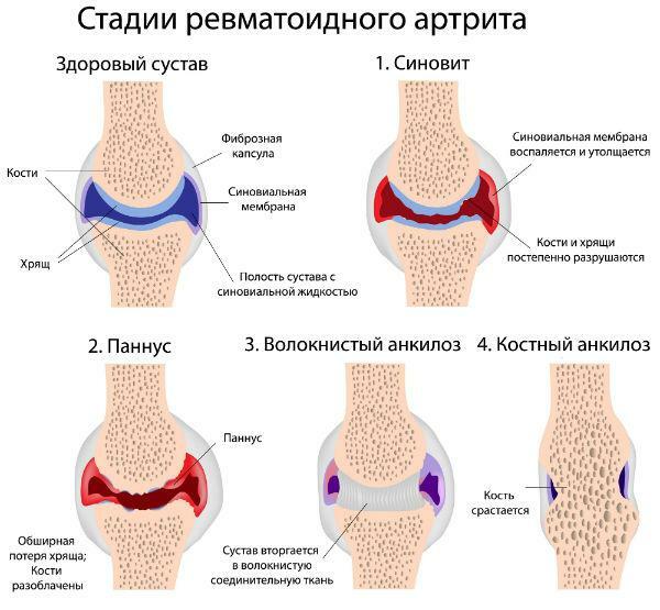 Stages of development of rheumatoid arthritis