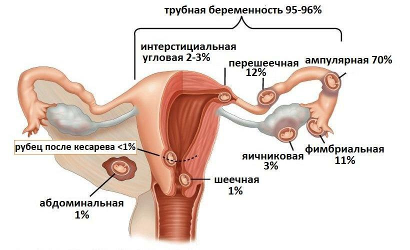 Typer af ektopisk graviditet og dens placering