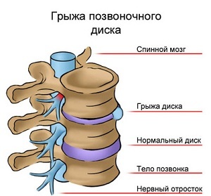 Hernia lumbar
