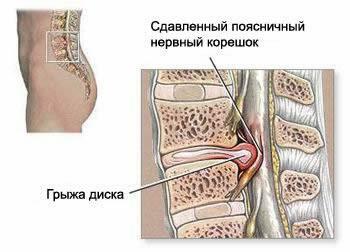 Herniated lumbar spine