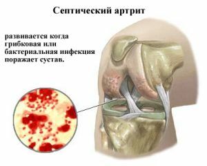 Põletikuline artriidi protsess