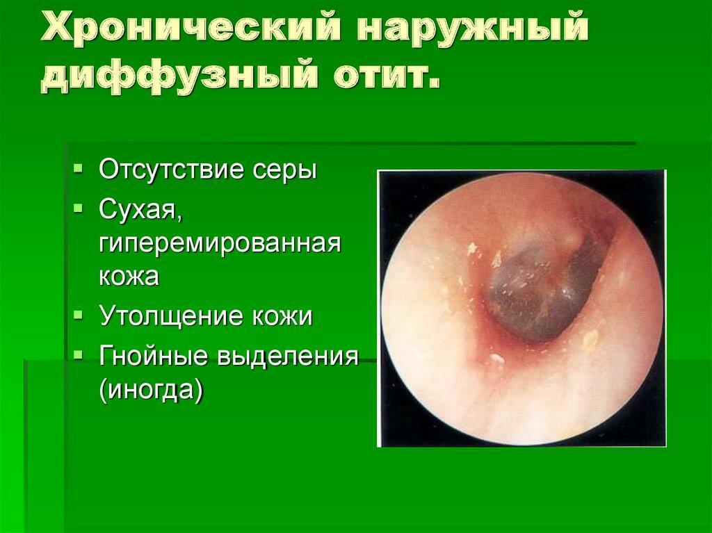 Difuznom mediju otitis