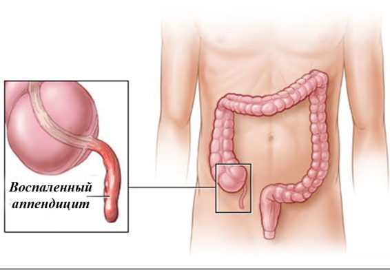 Appendektomi enligt Volkovich-Dyakonov genom pararektalt snitt enligt Lenander