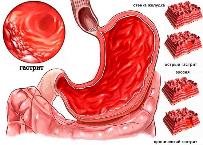 The stage of transition to a healthy stomach gastritis disease