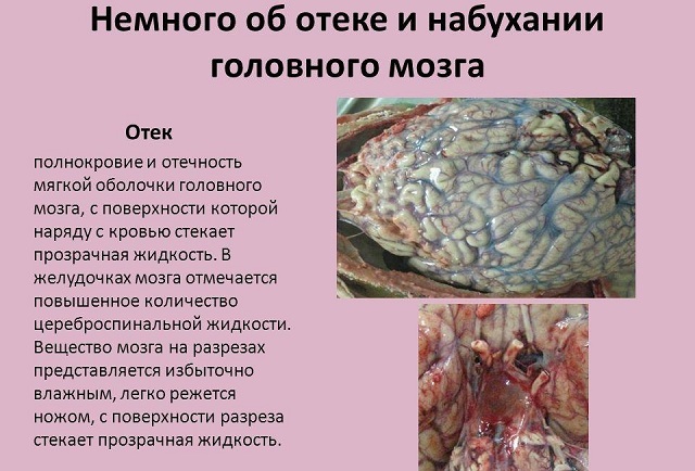 fotografija moždanog edema