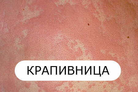 Urticaria in adults: symptoms and treatment, photo