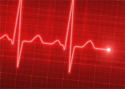Sinus arytmi i hjertet - hvad er det?