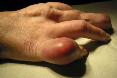 The fingers of the hands are twisted and swollen with gout