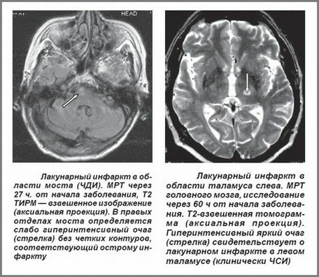 Lésions cérébrales sur IRM