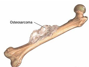 sarcoma óseo