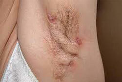 treatment of purulent inflammation of the lymph nodes under the armpits