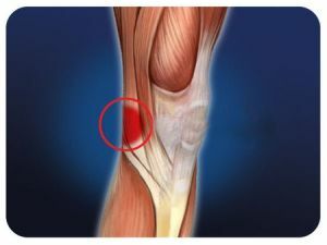 Popliteal median nerve: its injuries and treatment